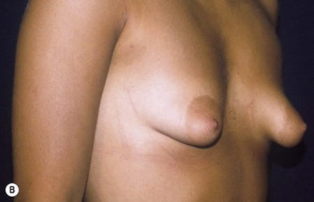 Puffy And Malformed Tits Lovely Areolas Plastic Surgery Pics