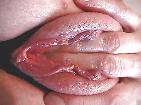 Abnormal vagina lips