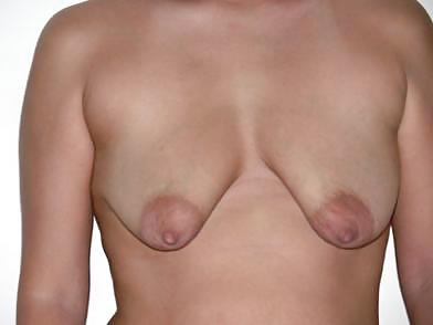 Deflated Tits