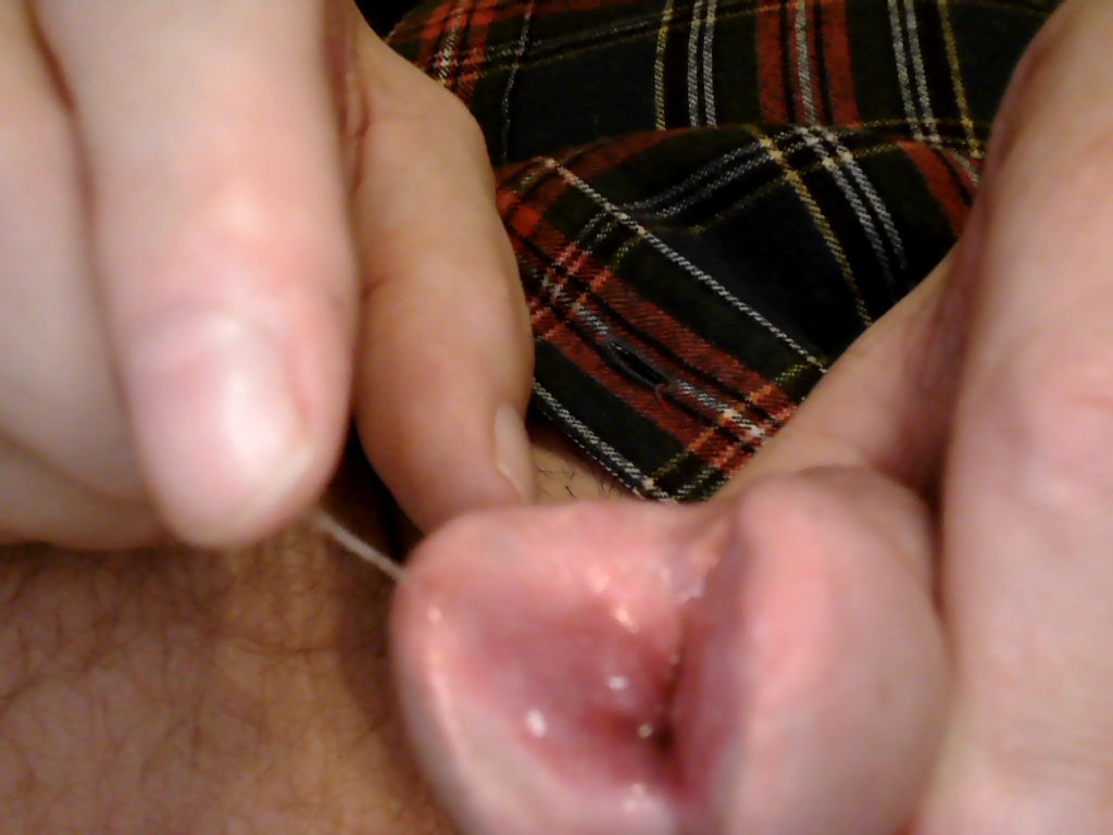 My Healed Split Glans 19 Pics Xhamster 1418