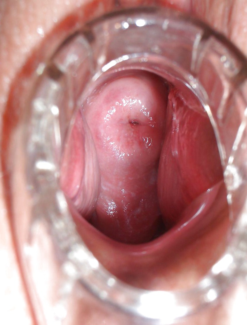 Stinging inside vagina.